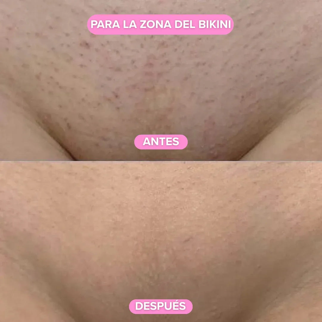 Depiladora Anivelle®